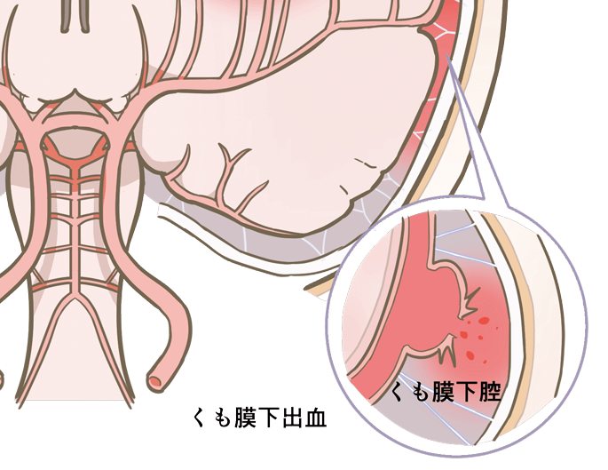 くも膜下