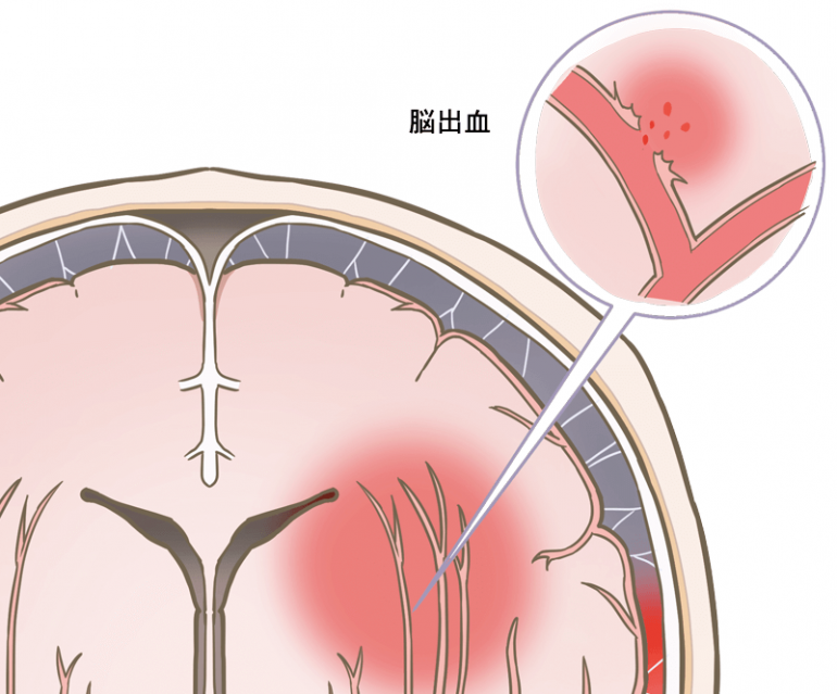 激しい 頭痛 脳 に 異常 なし