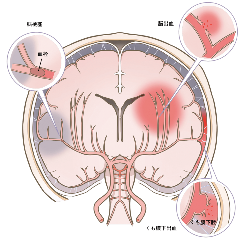 脳卒中とは
